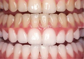 Teeth whitening hydrogen peroxide gel